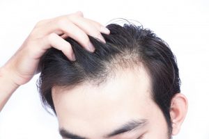 hair loss clinic richmond hill ontario